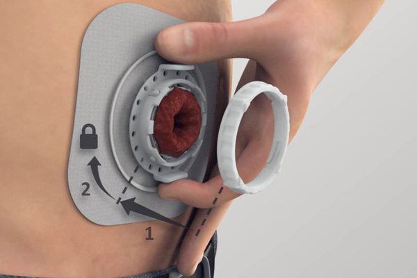 OstomyCure continues clinical trial to fully evaluate its TIES implant