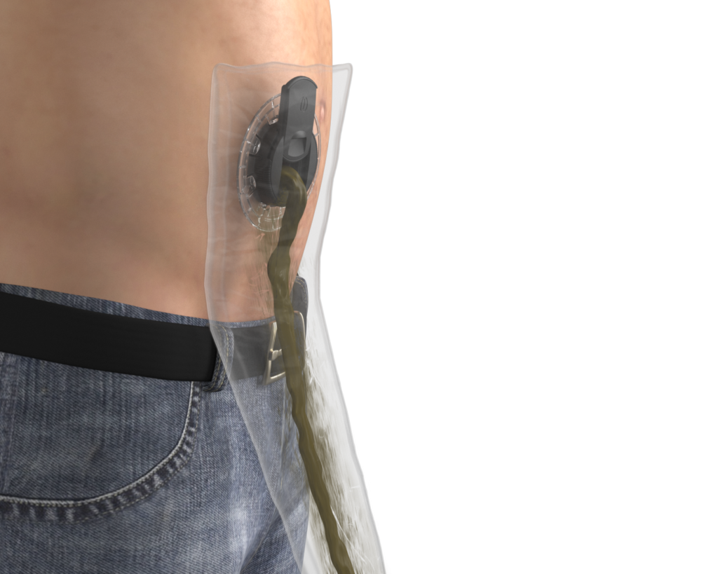 New device could 'revolutionise' lives of those living with stoma bags -  Med-Tech Innovation